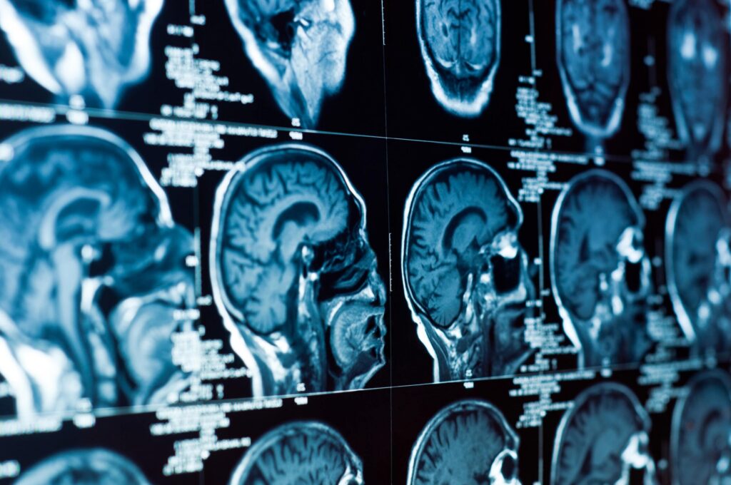 traumatic brain injury attorneys Vero Beach, FL