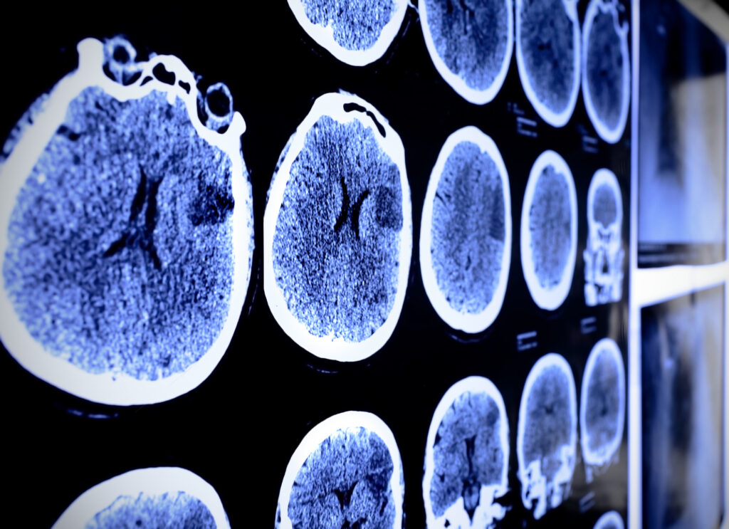 Brain Injury Lawyer Florida