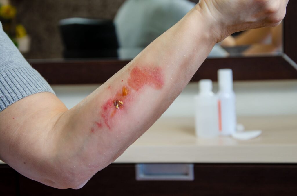 Burn Injury Tuttle Larsen